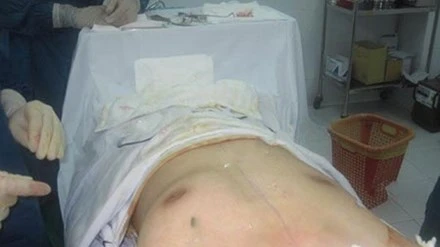 Hình ảnh một ca phẫu thuật nâng ngực ở nam giới.